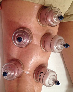 Cupping Set