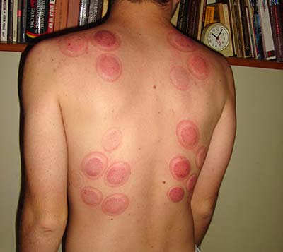 Cupping Marks